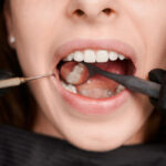 Understanding and Treating Dental Abscesses: A Guide