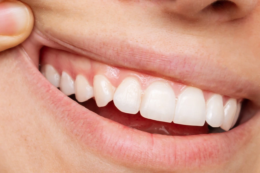 Healthy Gums: Tips for Maintaining Optimal Gum Health