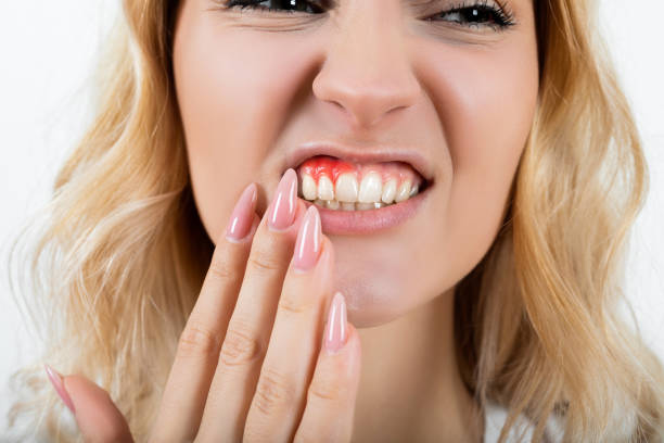 Are Bleeding Gums a Sign of Something Bigger?